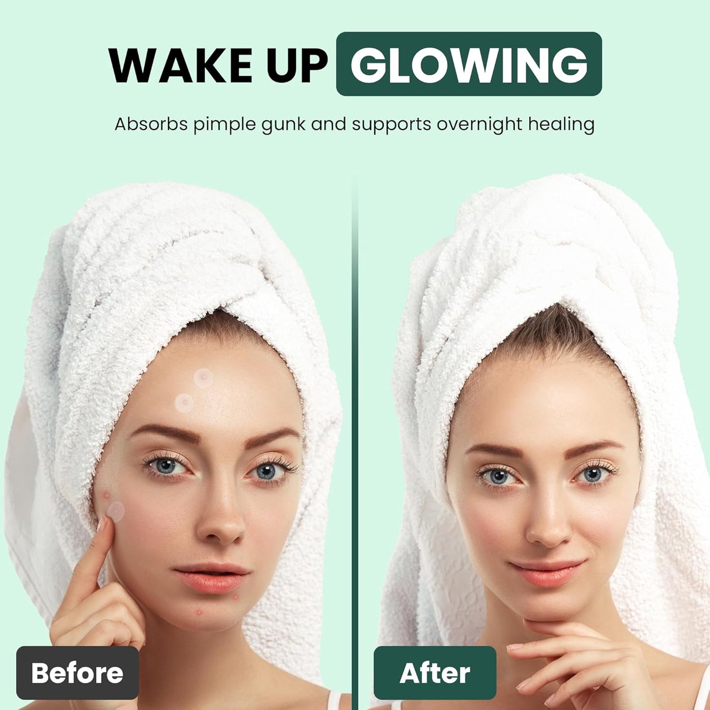 TheraSkin Pimple Patches | Korean Formulation Hypoallergenic | Micro Needle Patch | Hydrocolloid Waterproof Patches | Absorbs Excess Oil | Pimple & Acne Overnight | Invisible 9 Patches